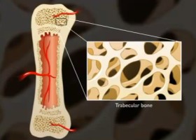 Csontritkulás (Osteoporosis)